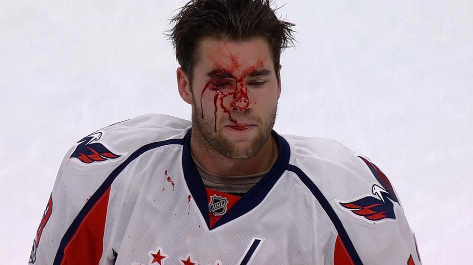 tom-wilson-bloody-face-1